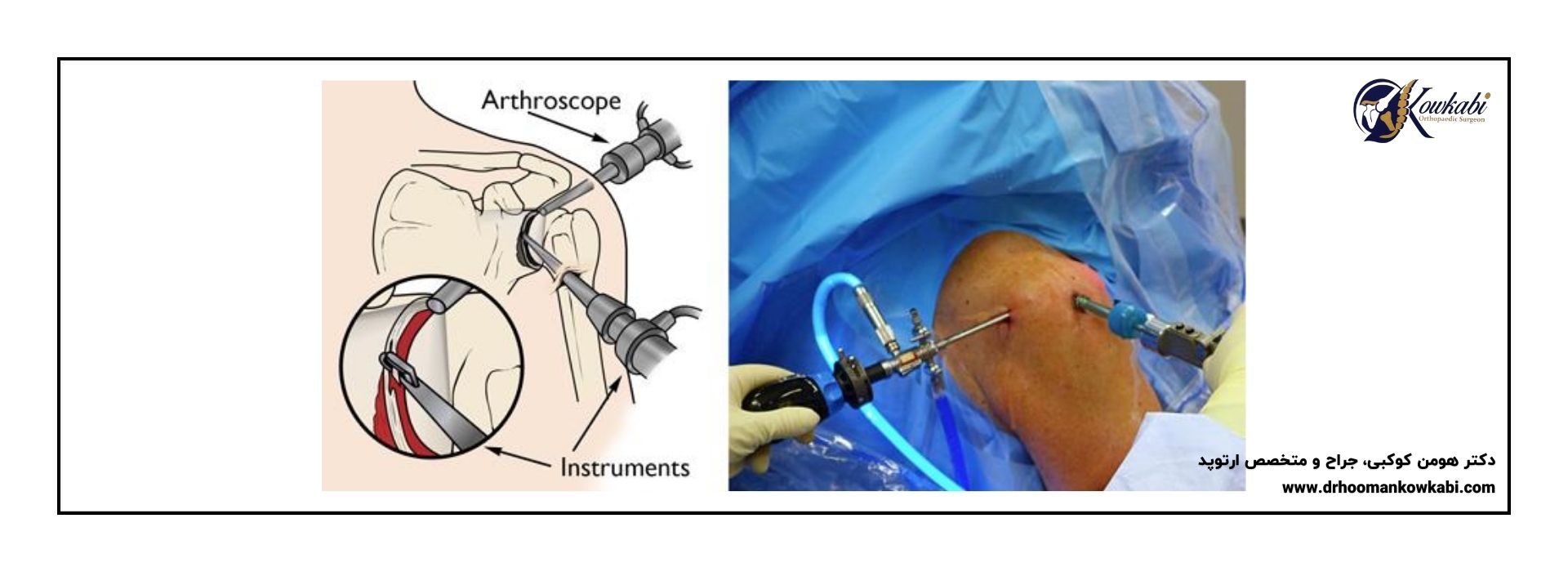 آرتروسکوپی شانه تهران