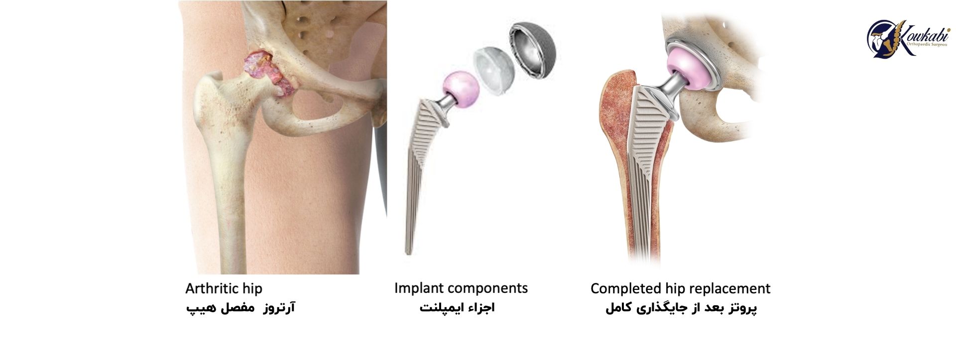 جراحی تعویض مفصل لگن