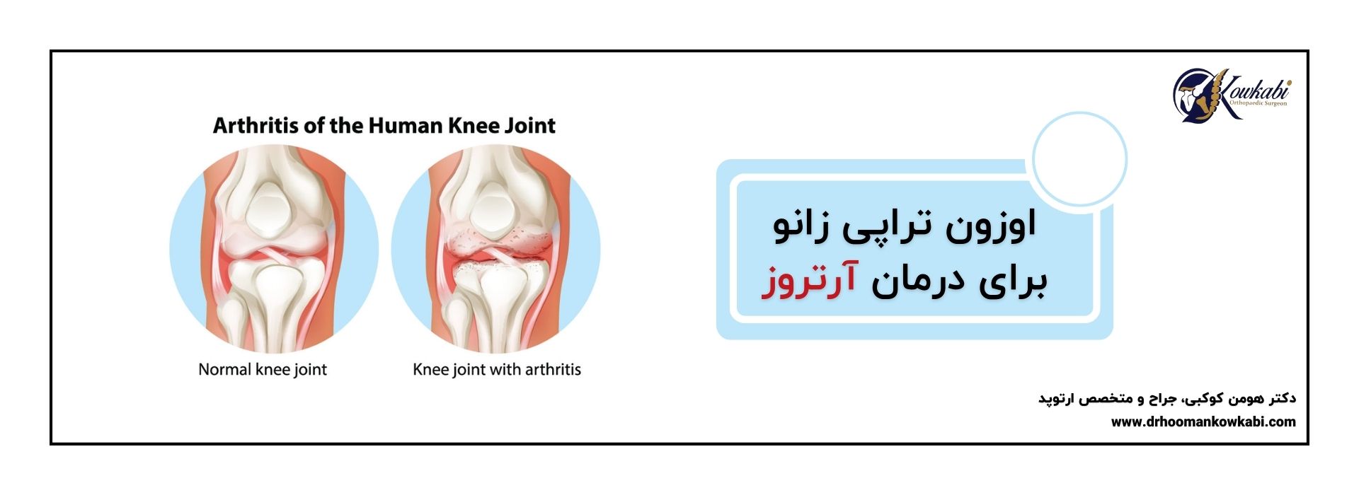 اوزون تراپی زانو در تهران