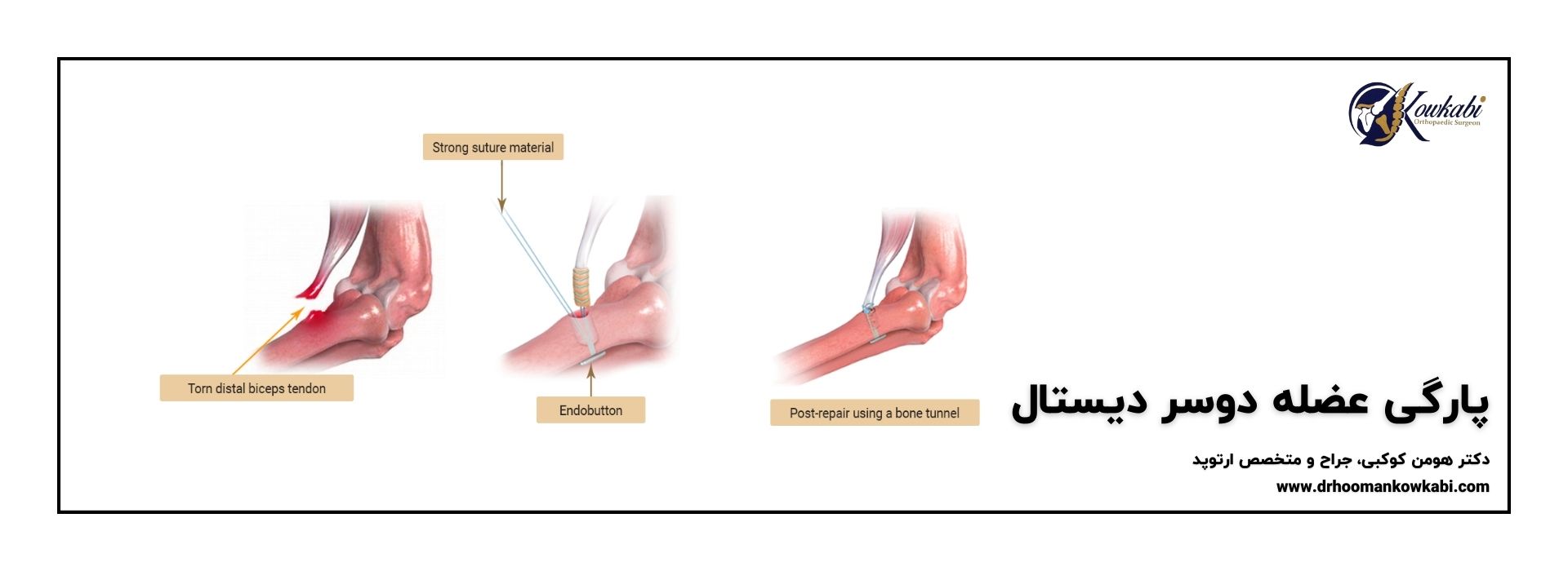 پارگی عضله دوسر دیستال