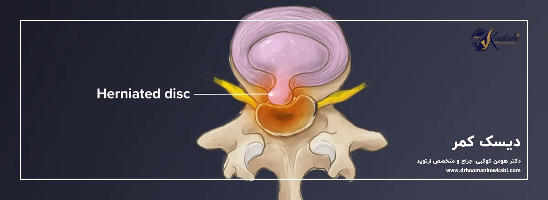 دیسک کمر