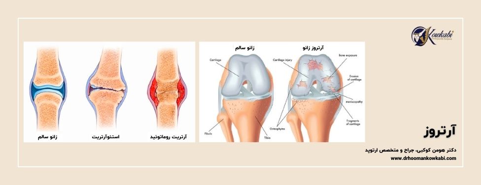 آرتروز چیست؟