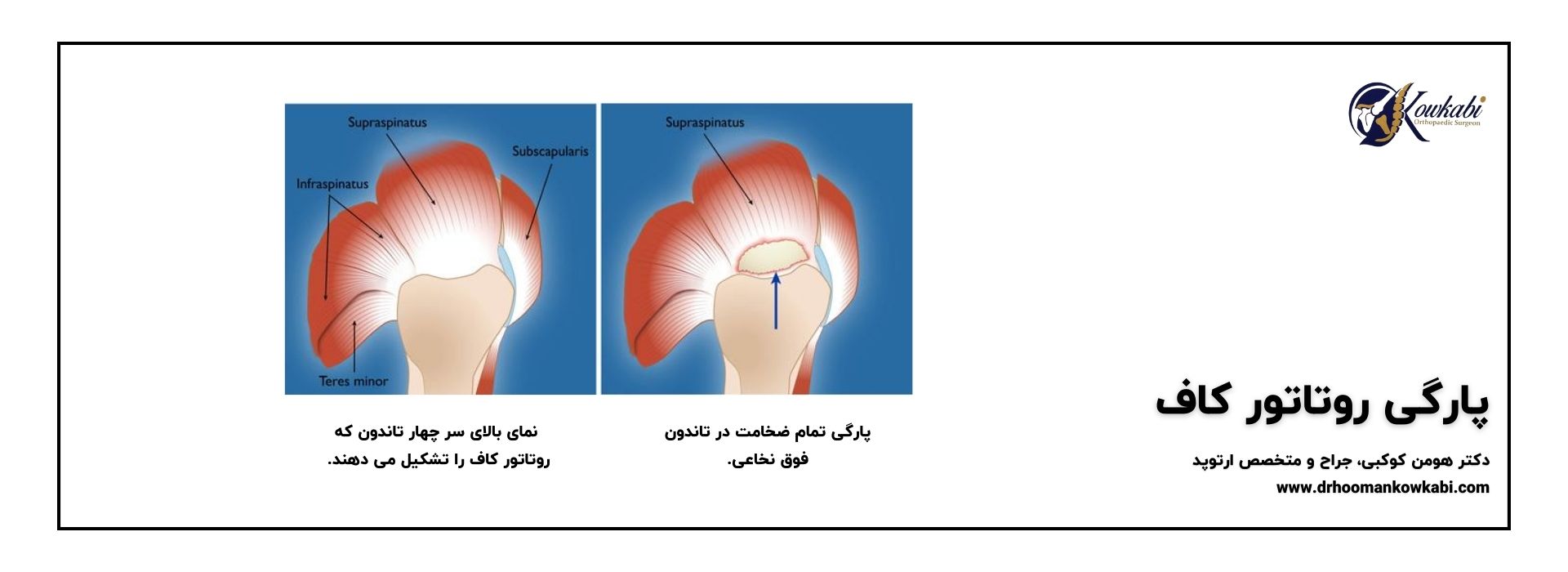 پارگی کامل تاندون شانه