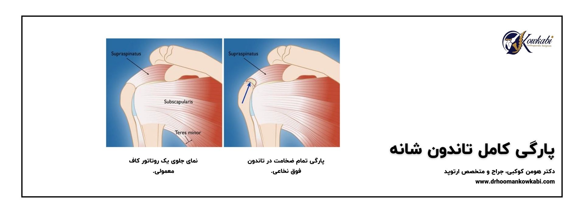 پارگی تاندون شانه بصورت کامل