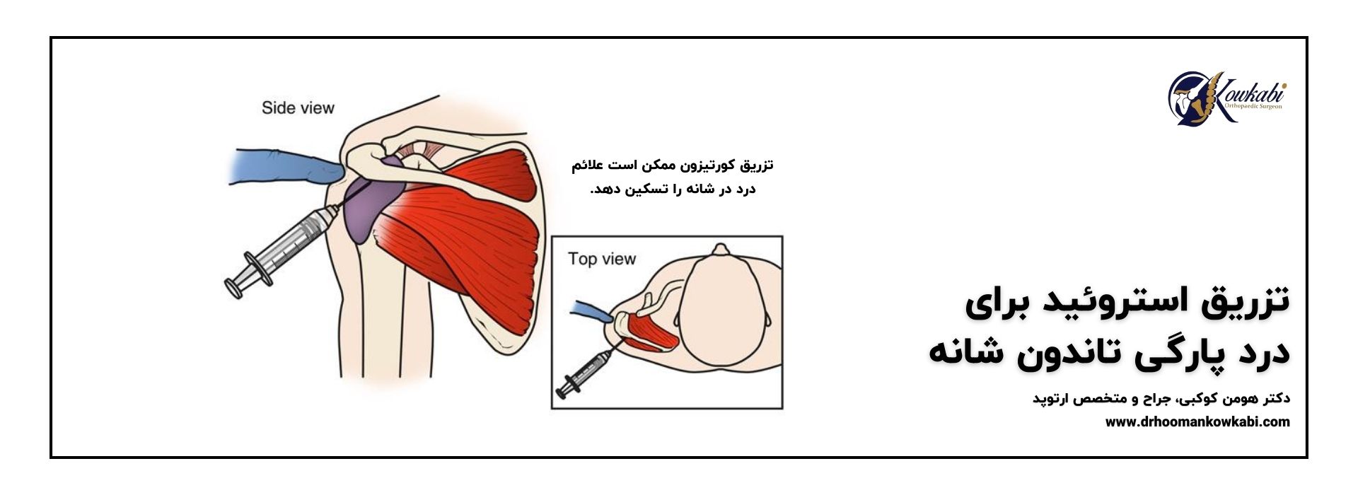 تزریق برای درمان پارگی تاندون شانه