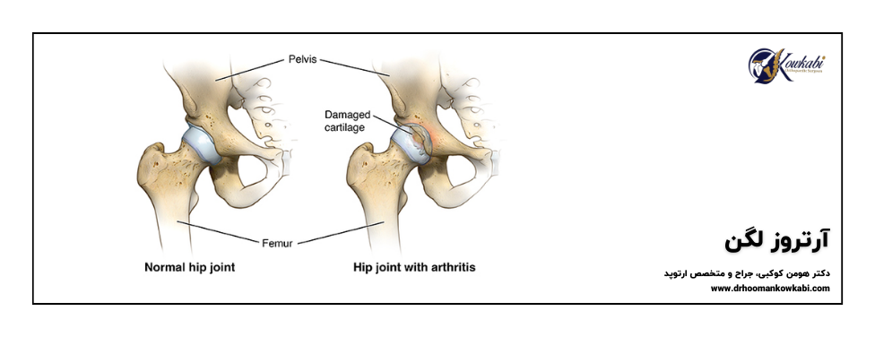 Hip Arthritis 2