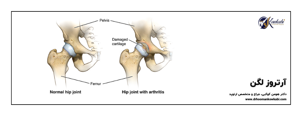 آرتروز لگن