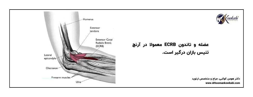 آرنج تنیس بازان