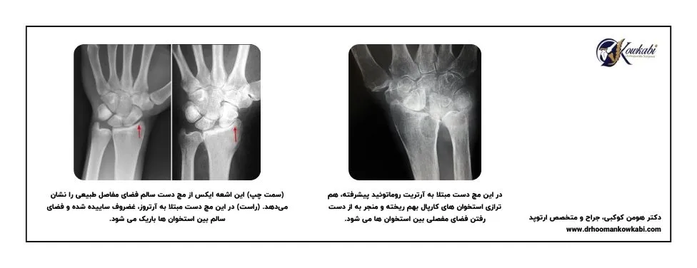 آرتروز مچ دست