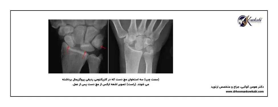 جراحی آرتریت مچ دست