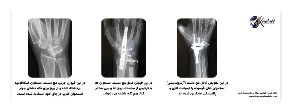 جراحی آرتروز مچ دست