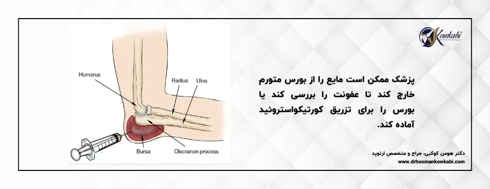 درمان بورسیت آرنج