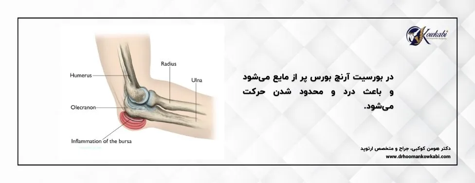 بورسیت اولکرانون