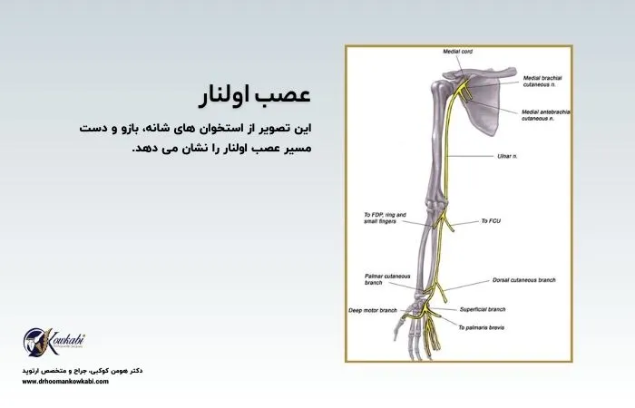 سندرم تونل کوبیتال