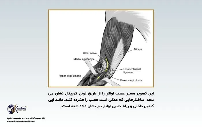 جراحی سندرم تونل کوبیتال