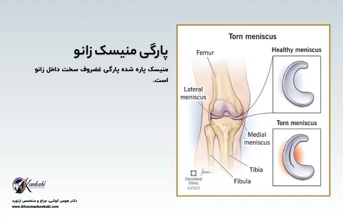 پارگی منیسک زانو