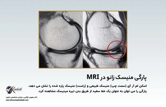 تشخیص پارگی منیسک زانو