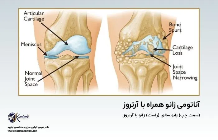 علت صدا دادن زانو