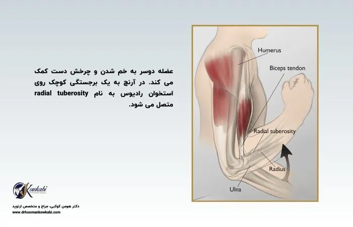 پارگی عضله دوسر بازو