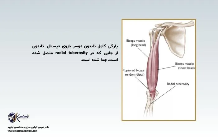 پارگی عضله دوسر بازو
