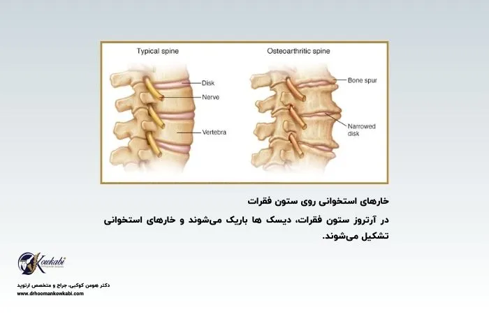 استئوآرتریت ستون فقرات