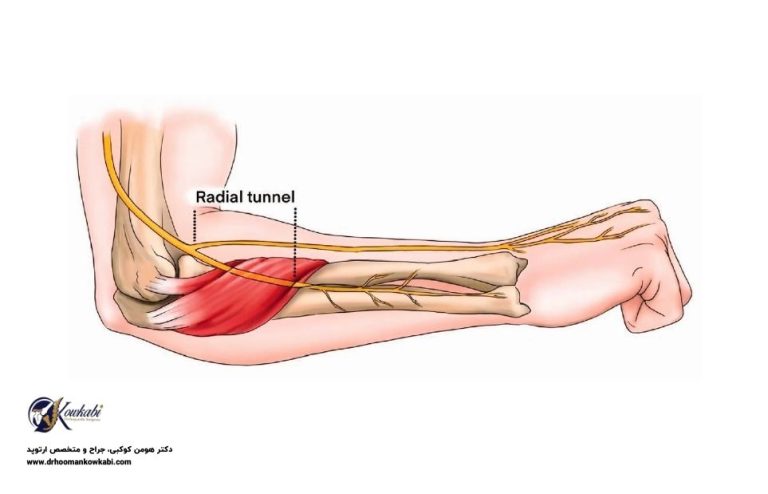 سندرم تونل رادیال