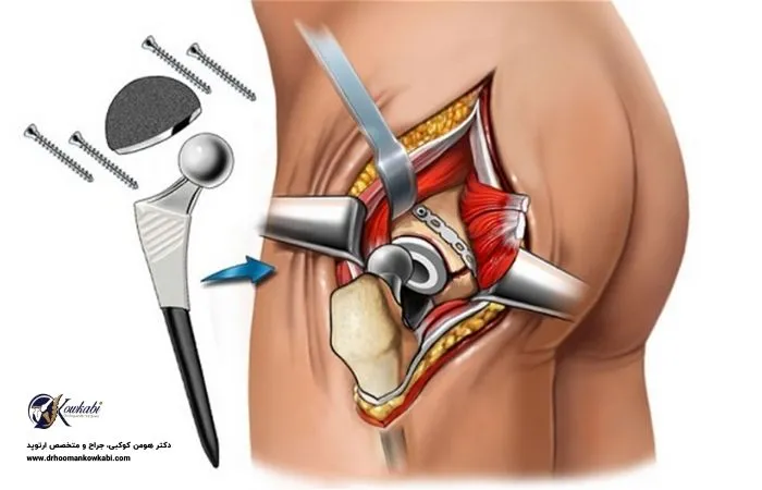 بهترین جراح تعویض مفصل لگن