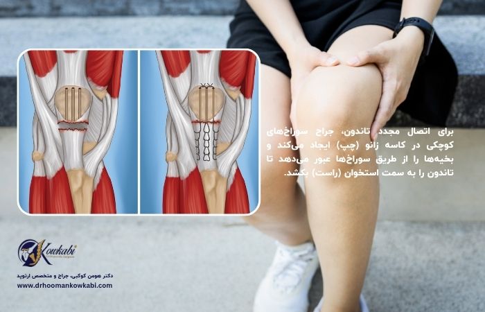 پارگی تاندون زانو