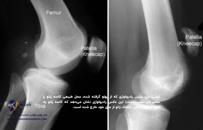 پارگی تاندون زانو