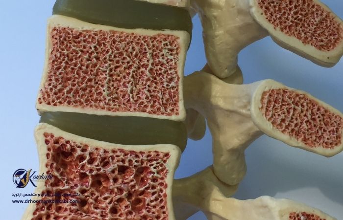 پیشگیری از پوکی استخوان