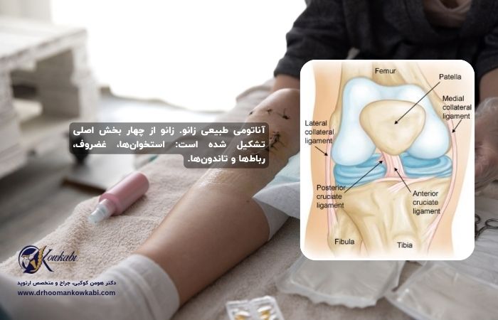 پارگی رباط صلیبی قدامی (ACL) زانو پارگی رباط صلیبی
