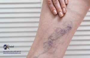 ترومبوز سیاهرگی عمقی