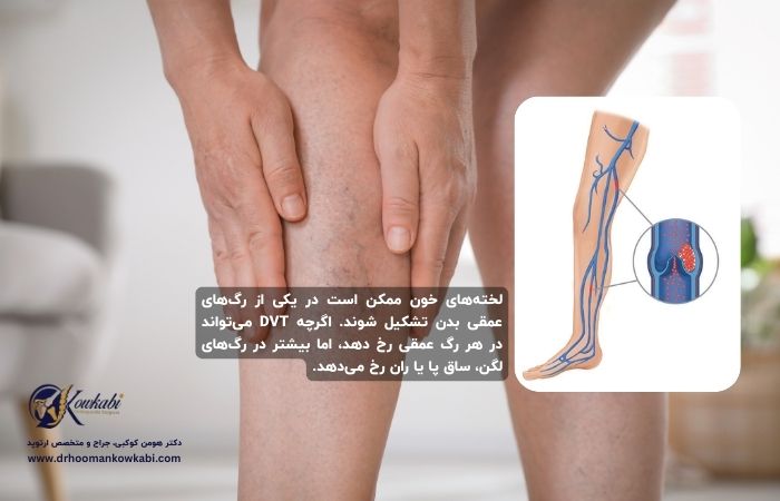 ترومبوز سیاهرگی عمقی (DVT): علل، علائم و راههای پیشگیری و درمان ترومبوز سیاهرگی عمقی