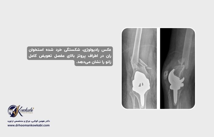 شکستگی پس از تعویض مفصل زانو