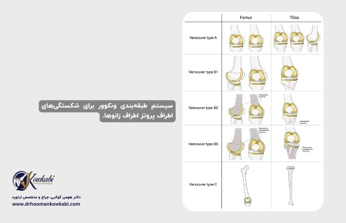 شکستگی پس از تعویض مفصل زانو