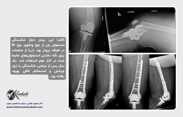 شکستگی پس از تعویض کامل زانو