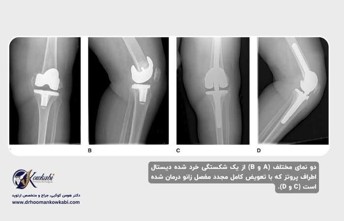 شکستگی پس از تعویض مفصل زانو