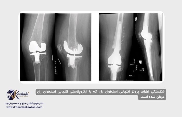 شکستگی پس از تعویض مفصل زانو