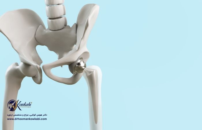 لگن شکستگی پس از تعویض مفصل ران