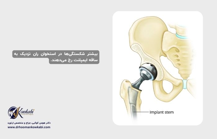 شکستگی پس از تعویض مفصل ران