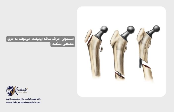 شکستگی پس از تعویض مفصل ران