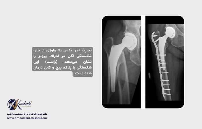 شکستگی پس از تعویض مفصل ران