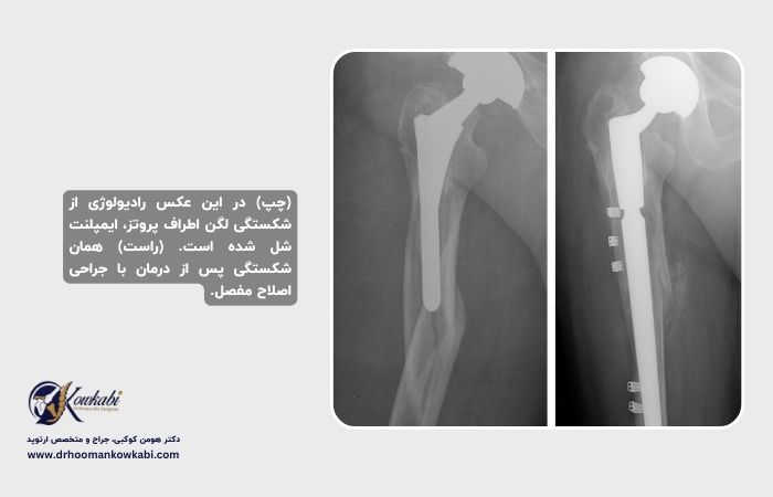 شکستگی پس از تعویض مفصل ران