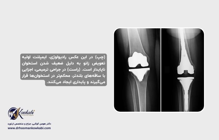جراحی مجدد تعویض مفصل زانو