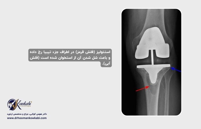 جراحی مجدد تعویض مفصل زانو