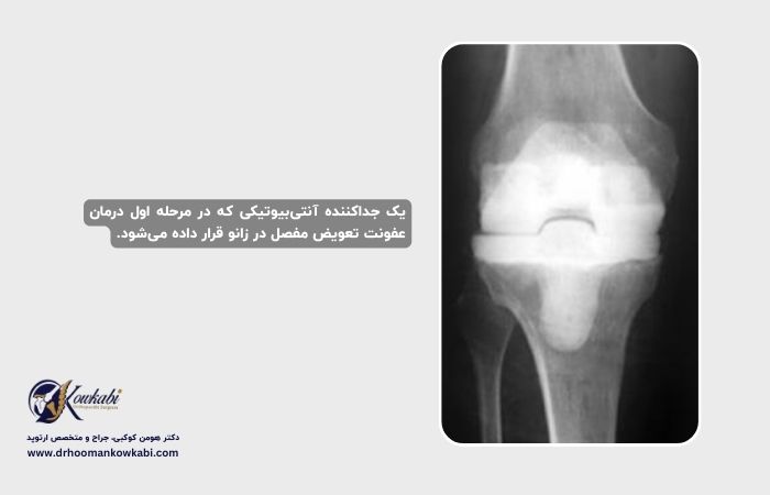 جراحی مجدد تعویض مفصل زانو