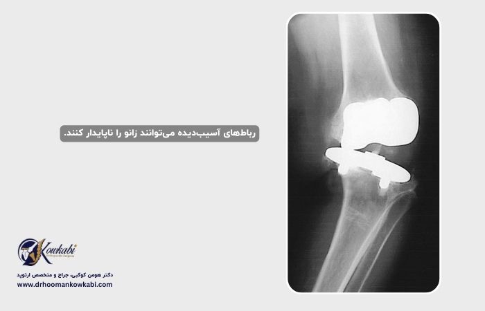 جراحی مجدد تعویض مفصل زانو