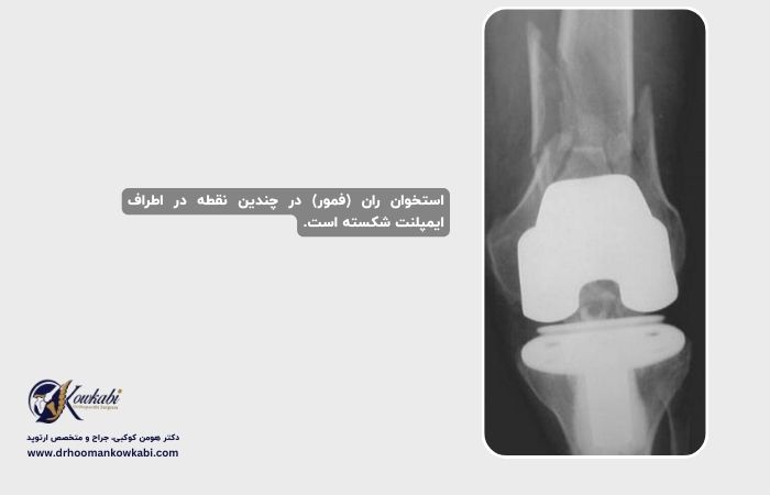 جراحی مجدد تعویض مفصل زانو