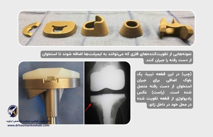 جراحی مجدد تعویض مفصل زانو