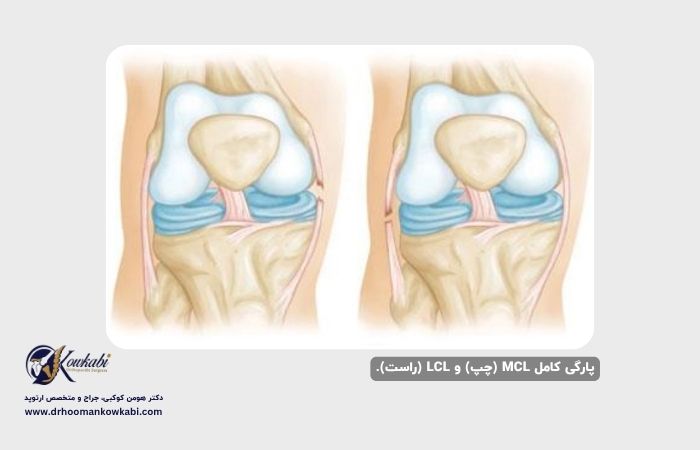 آسیب رباط جانبی زانو: راهنمای کامل علل، علائم و درمان آسیبهای رباط جانبی